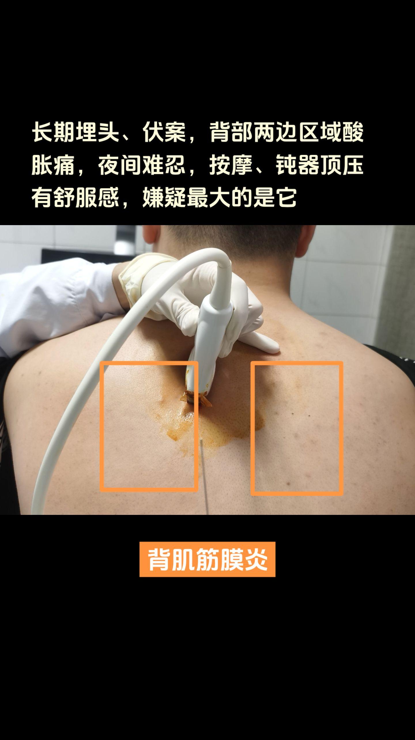 长期埋头、伏案、操作电脑，背部两侧肩胛区疼痛、酸胀，夜间明显，按摩、钝压舒服，伸展运动可缓解。