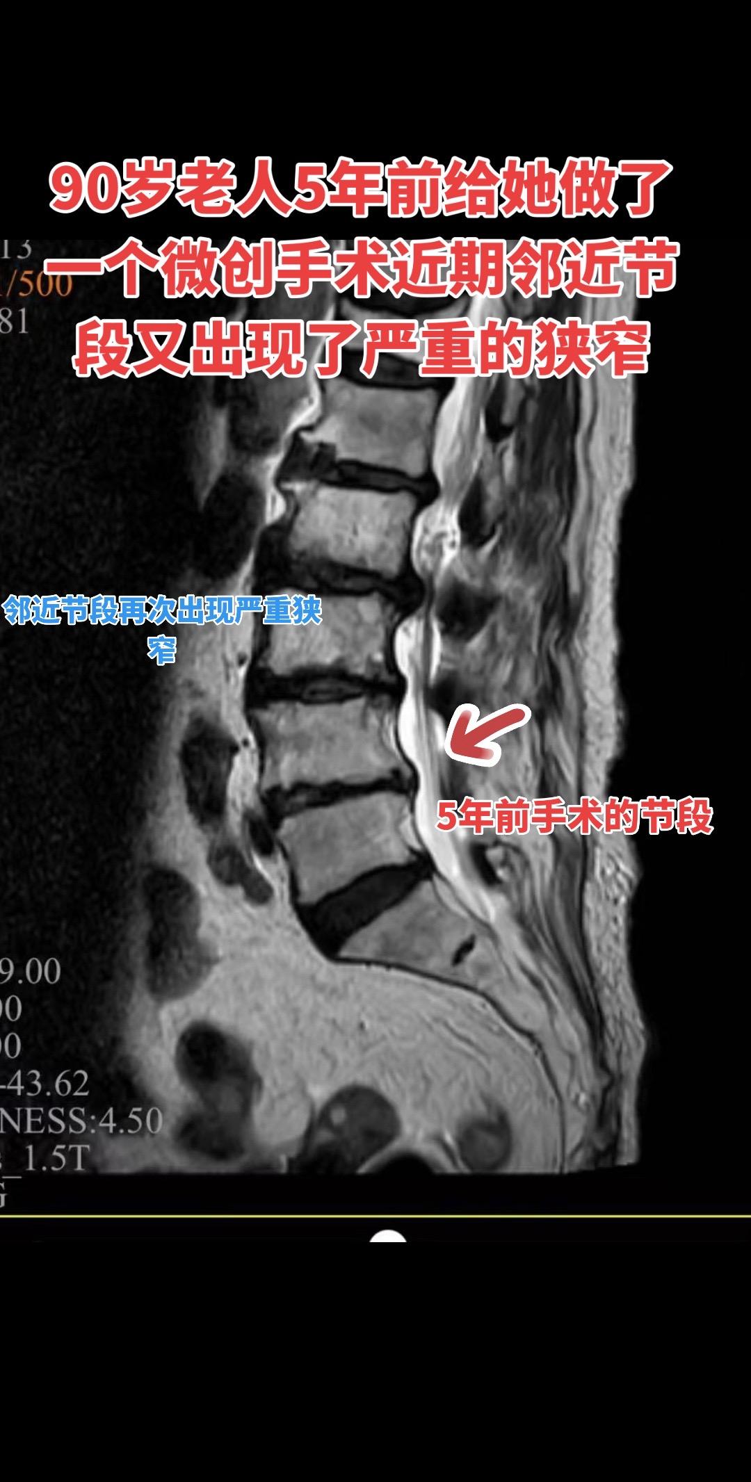 高龄腰椎管狭窄老人的痛苦。老年化社会，这种高龄病人越来越多了，一个90...