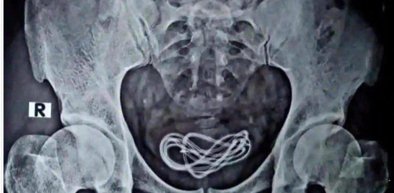 看病的时候，骗医生就是想见阎王！他30岁，自诉剧烈腹痛一天来就诊。就诊的时候，他