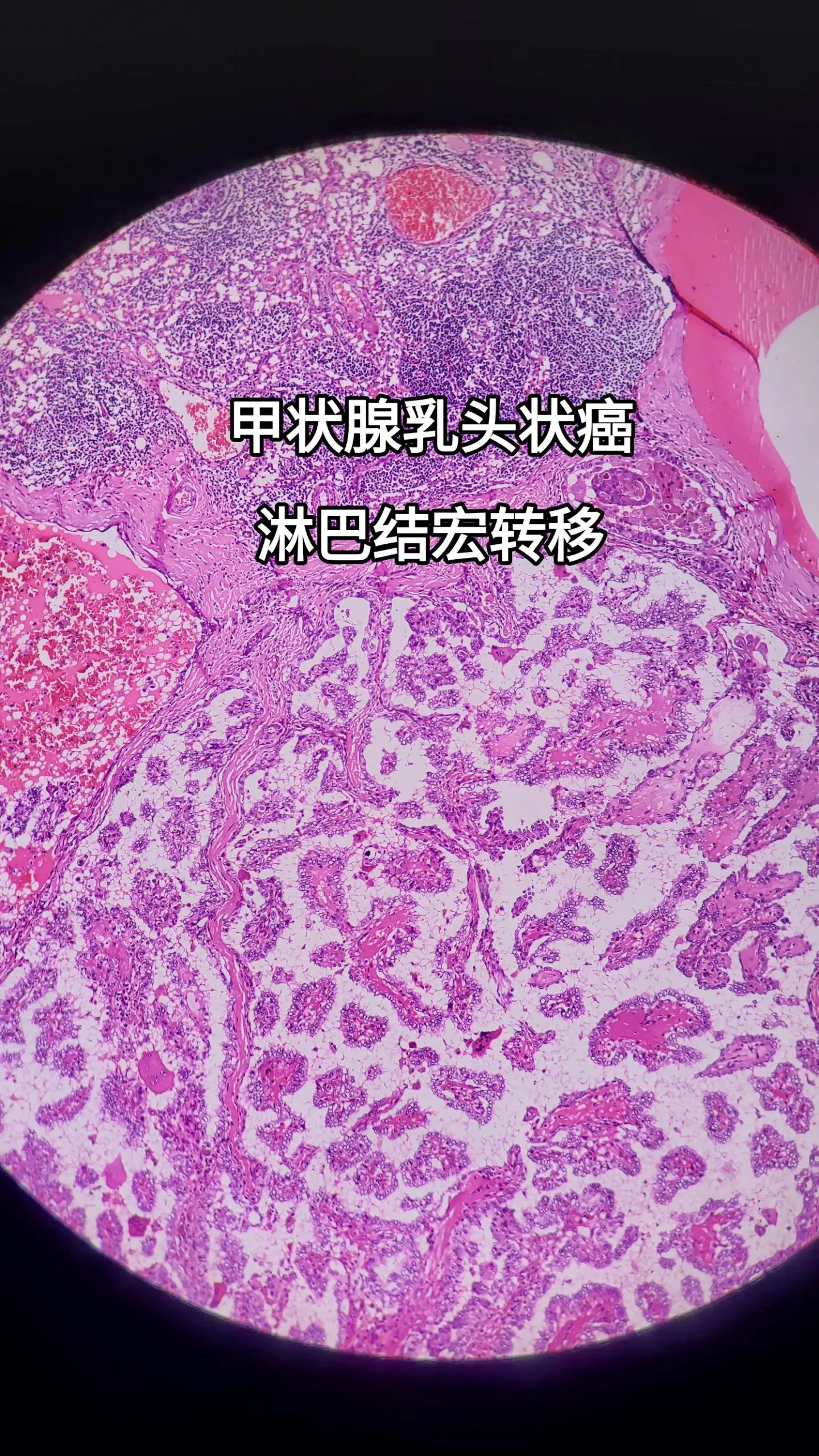 甲状腺乳头状癌 淋巴结转移