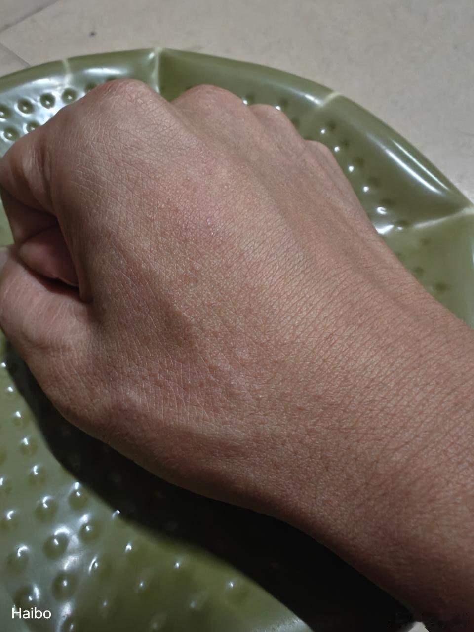 梁医生，这是青霉素过敏吗？刚好这一周在吃治疗幽门螺旋杆菌的药，今天晚上发现手上长
