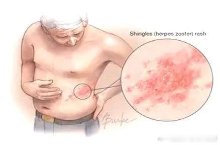 #张桂梅患带状疱疹仍坚持陪考#敬佩张桂梅老师！带状疱疹疼痛难忍，建议还是及早治疗