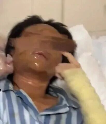 女主播称被伪装的包裹炸伤，面部损毁严重，家门口监控拍下一戴帽