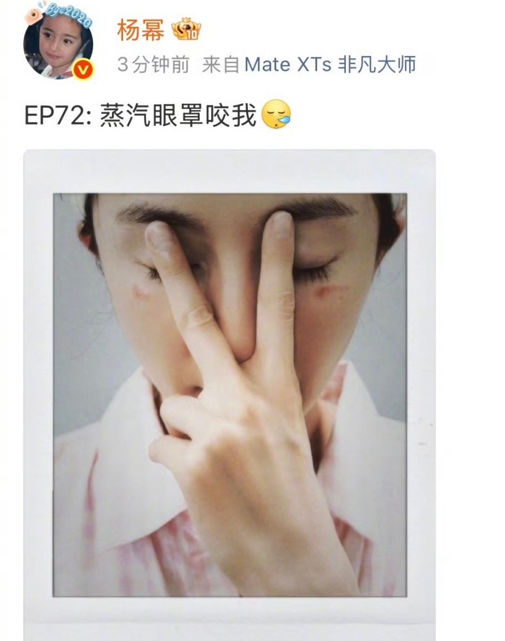 杨幂脸被蒸汽眼罩烫伤了话题爆了 