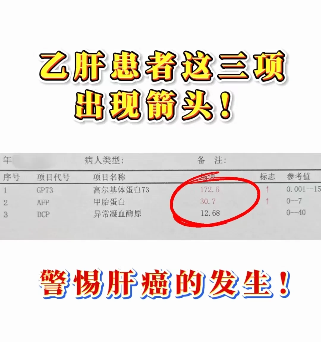 乙肝患者必看：三大指标与肝癌的密切关系！
