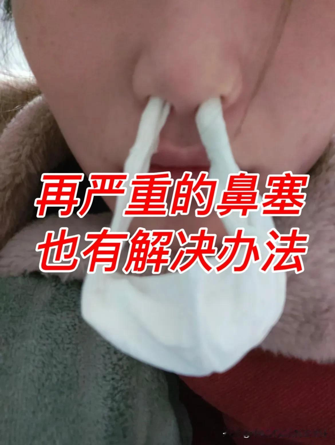 再严重的鼻塞，都有解决办法！

大部分鼻炎患者都会被鼻塞所困扰，今天给大家说说3