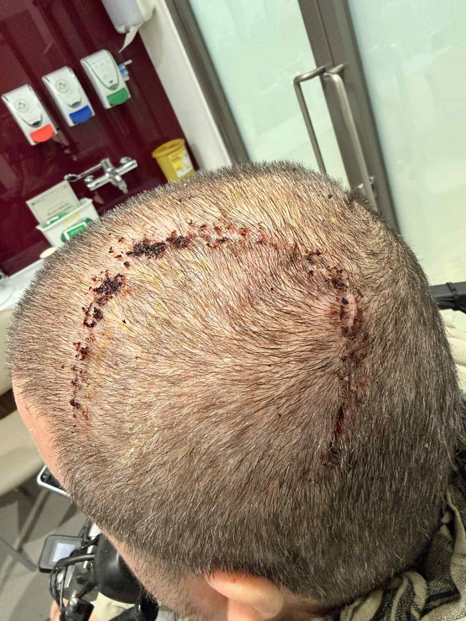 Neuralink第18号植入者Jon L. Noble分享100天术后体验3月