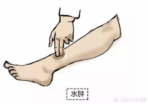 #全民营养提升计划# 【腿上出现这3个症状，要警惕血管堵塞】1、肿胀疼痛如果下肢