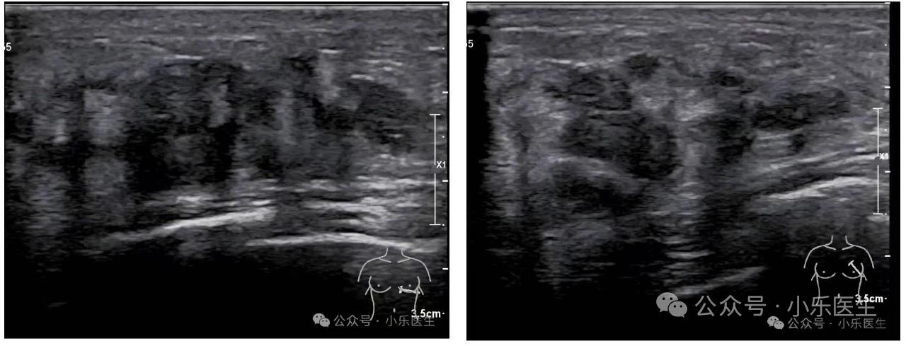 哺乳期乳腺炎要排除恶性的可能。女，30岁，产后8个月。乳腺肿块伴腋窝淋...