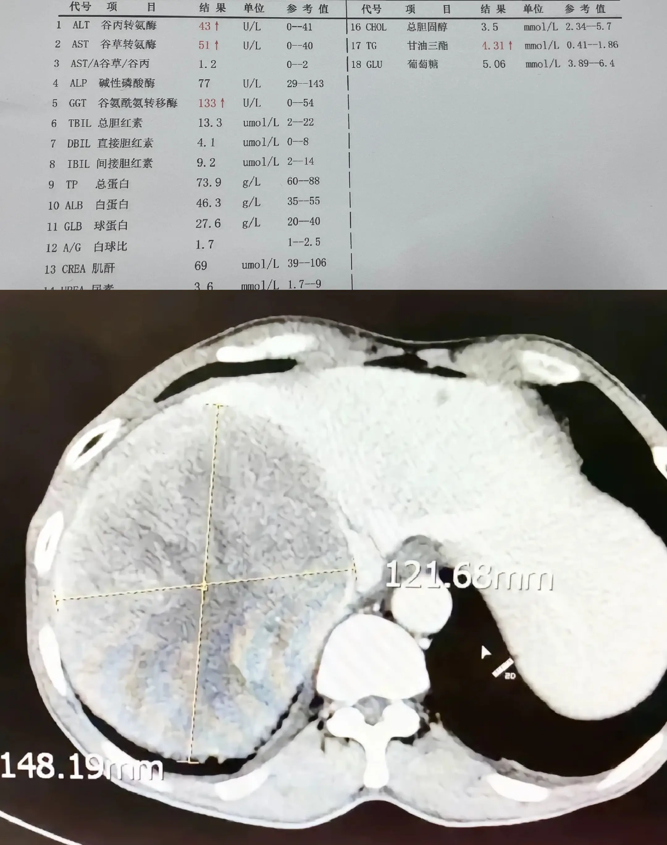 见过这么大的济南乙肝患者右上腹持续胀痛3个月才来检查，增强CT后发现肝...