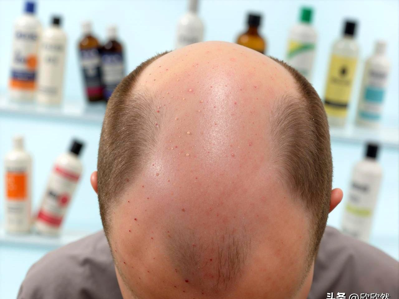 你有没有发现，身边40多岁的老哥们儿，头发好像都不太富裕？
我闺女前几天就掰着手