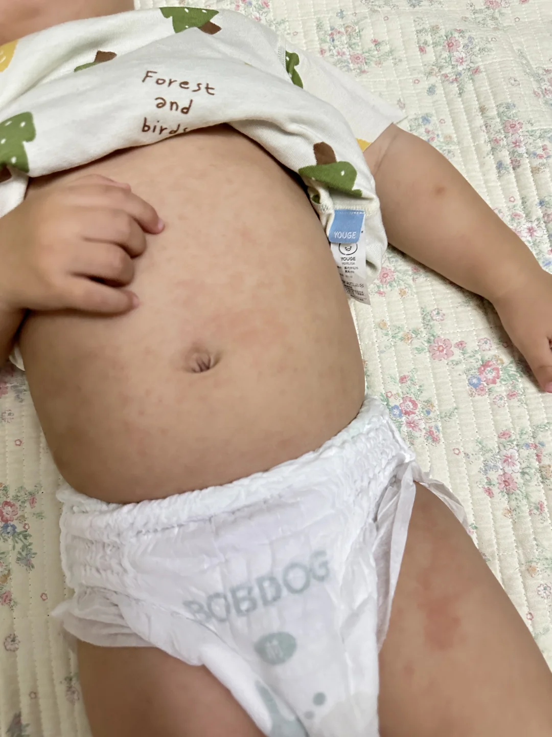 发烧过后疹子怎么办呀