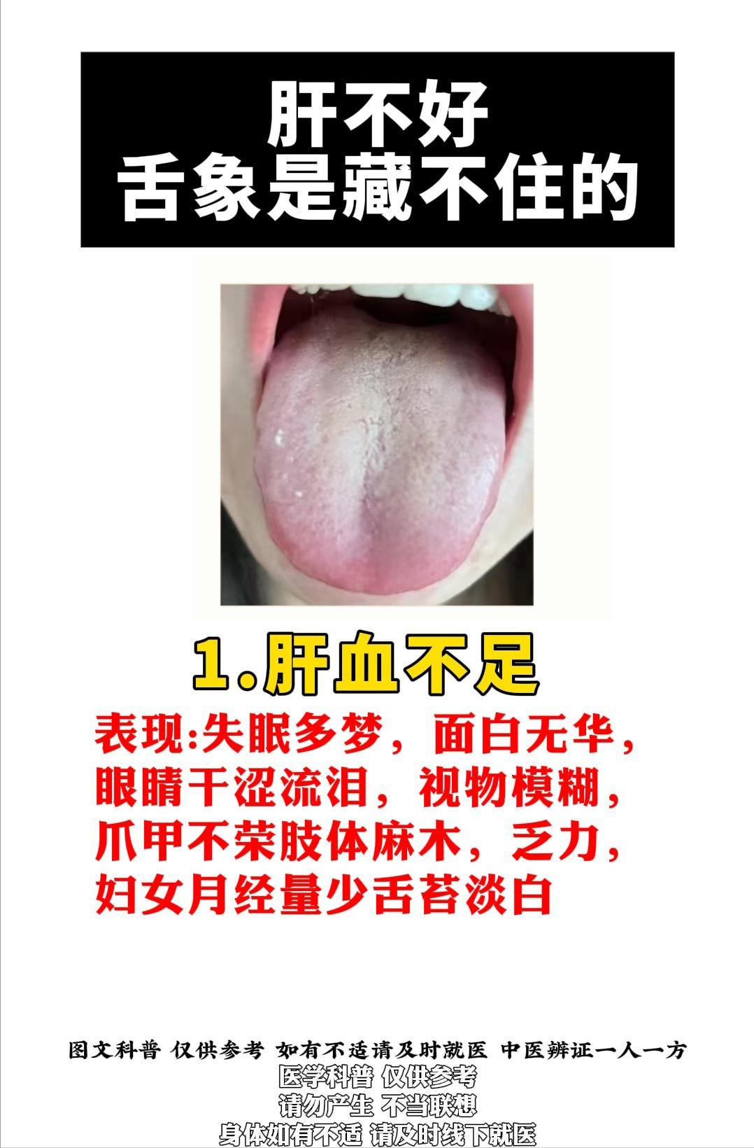 肝不好，舌象是藏不住的！

1、肝血不足——四物tang
2、肝胆湿热——龙胆泻