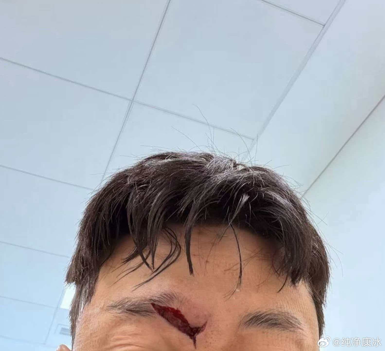高准翼这个伤口看着有点瘆人。早日康复。山东泰山