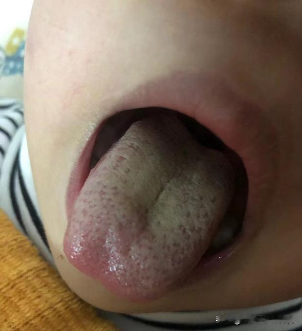 孩子积食，怎么通过舌头判断？宝妈必备技能
 
孩子不能正确表达症状，所以小儿“望