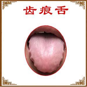 齿痕舌还在健脾祛湿，中医却说你是阳虚！
 
 
舌头胖大有齿痕，大部分人都认为是