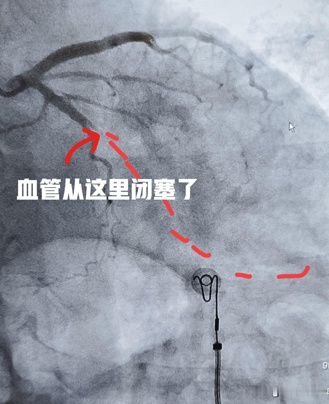药物球囊是如何工作的?来看看前几天做过的一台药物球囊手术。51岁男性患者，间断胸
