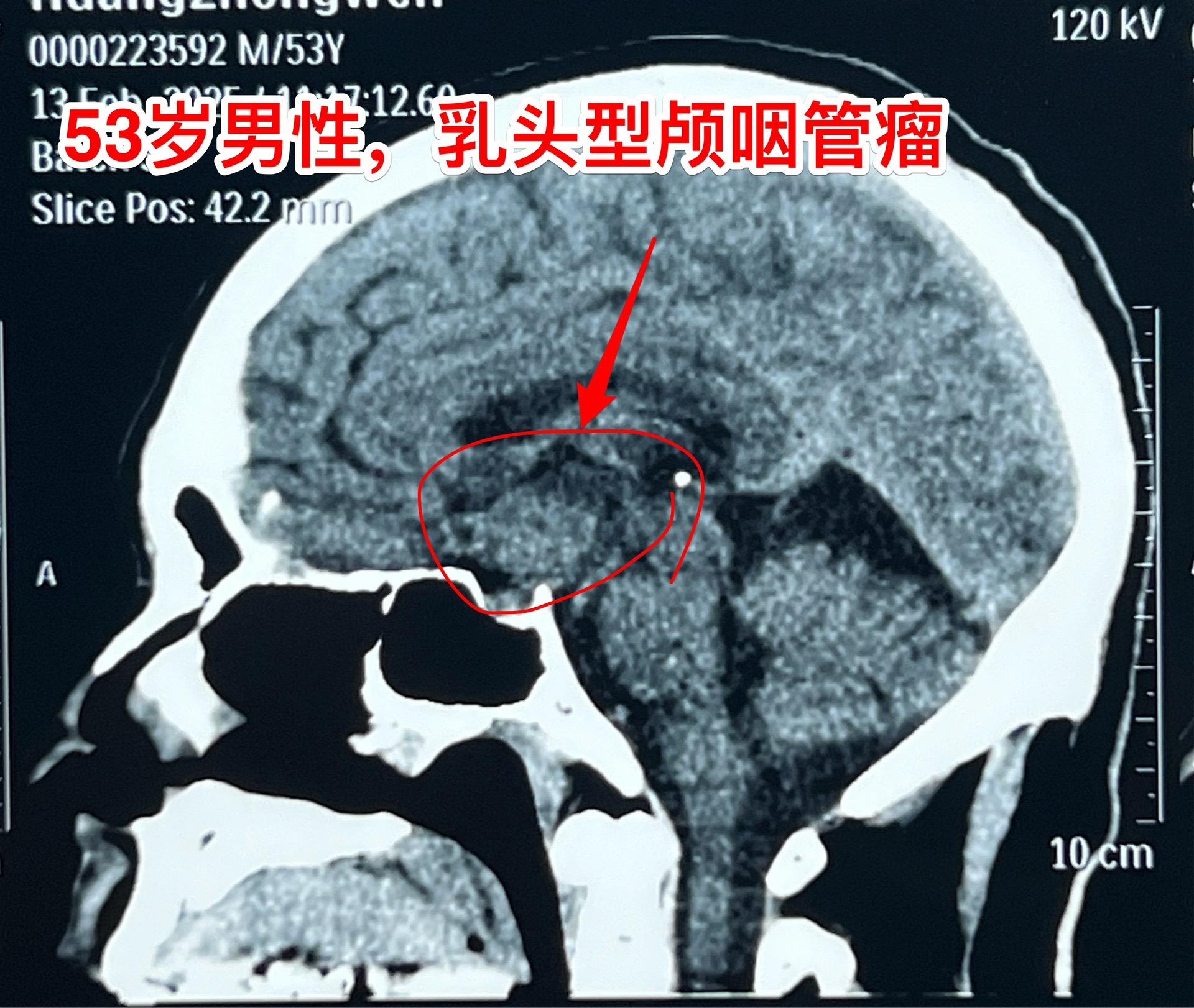 一天两个颅咽管瘤手术医生是很辛苦的 今天按计划作了两个颅咽管瘤手术。这...