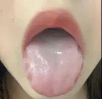 水汪汪的舌头，小心阳虚寒湿重！
哈喽朋友们，最近有个25岁的小姑娘来找我，一看她