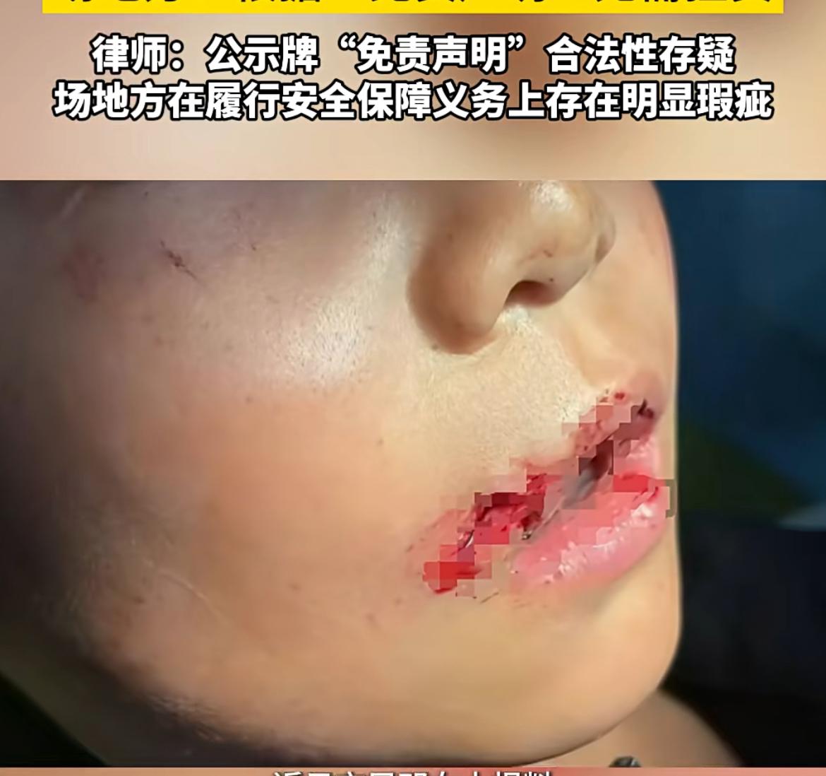 广州一 9 岁儿童玩滑板摔伤，其母亲质疑场地有问题，监管不到位。场地方则称他们和