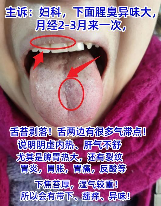 今日舌诊案例分析：湿热下注，阳虚寒湿，肝郁克脾，寒湿血瘀[谢谢][谢谢][谢谢]