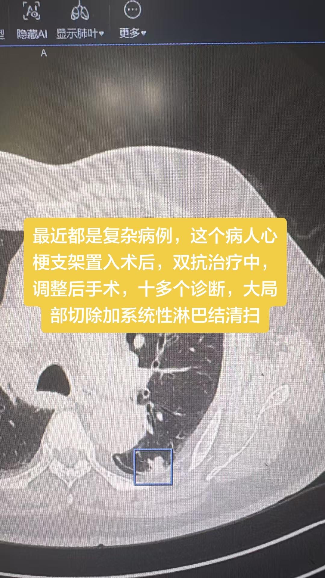 最近都是复杂病例，这个病人心梗支架置入术后，双抗治疗中，调整后手术，十...