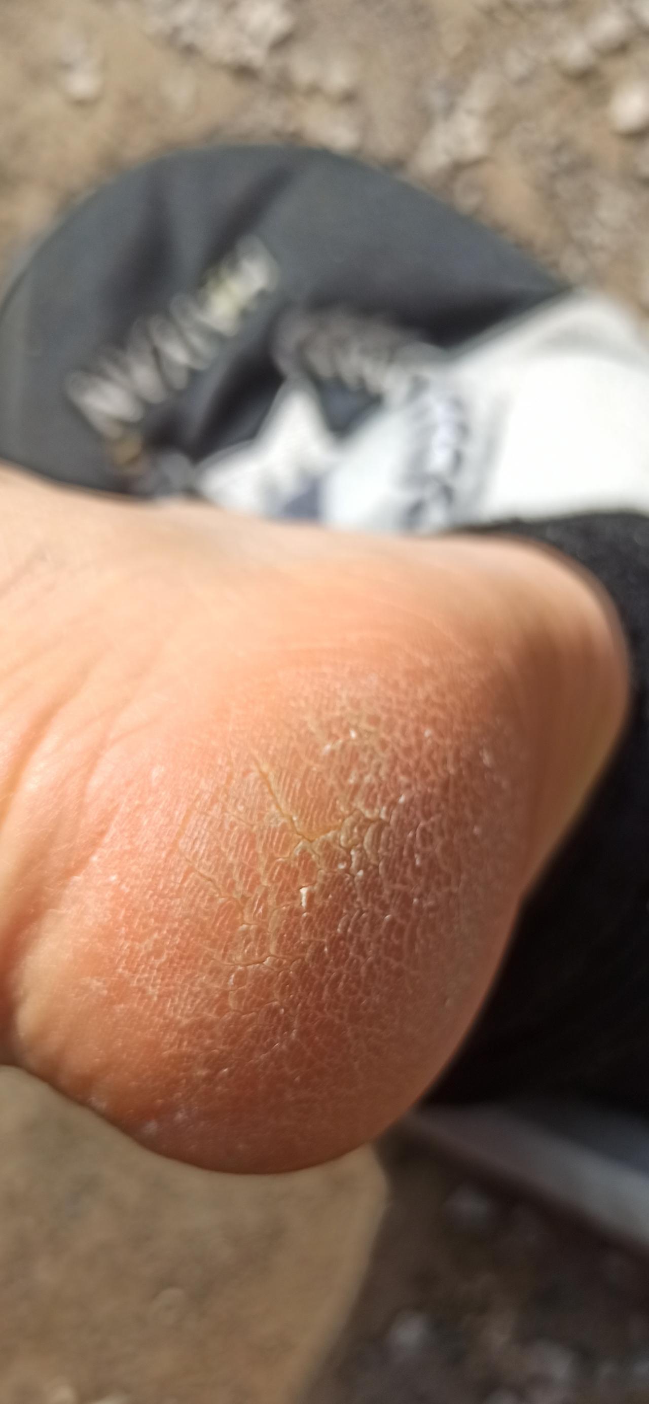 都四月份了，为啥足跟还这么糙？以前不是这样的，就是这两年开始，脚跟又粗又厚又开裂