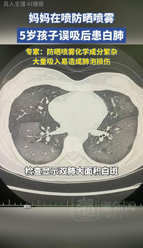 河南郑州，一5岁男孩在妈妈给自己喷防晒喷雾时站得太近，不慎吸入大量喷雾颗粒，很快