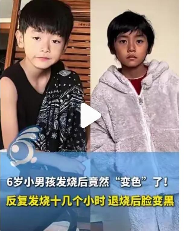 退烧后脸变黑看着孩子的变化太心疼了，希望他能快点好起来！呼吸道疾病高发期，家长们