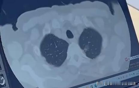 不抽烟也得肺癌？年轻女性患肺腺癌的真相让人意外！"我平时连烟味都闻不得，怎么就得