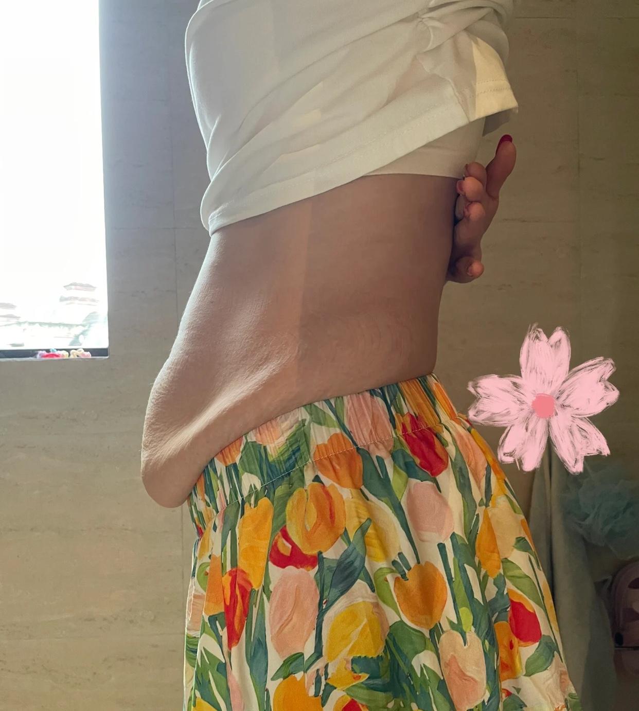 这肚子还能恢复吗？
双胞胎落地孩子白白胖胖，
婆婆公公和老公都在客厅抱着嘻嘻哈哈
