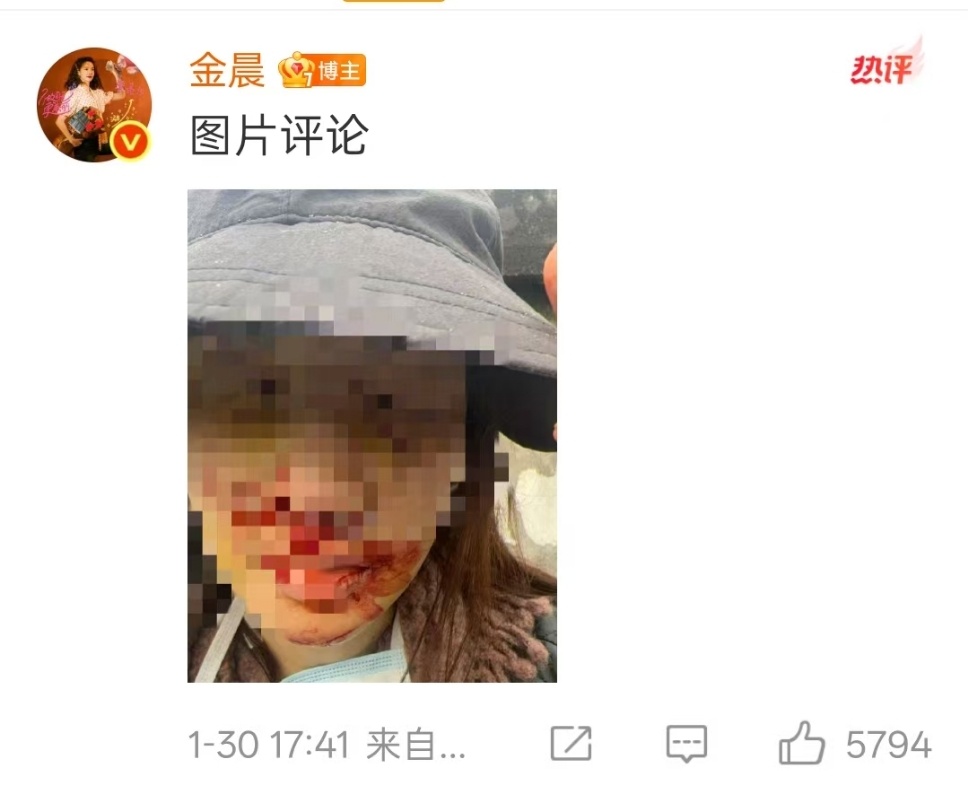 金晨发文道歉，称因躲避路边出来的犬只而出了车祸，事后伤情严重做了手术，事后知道车