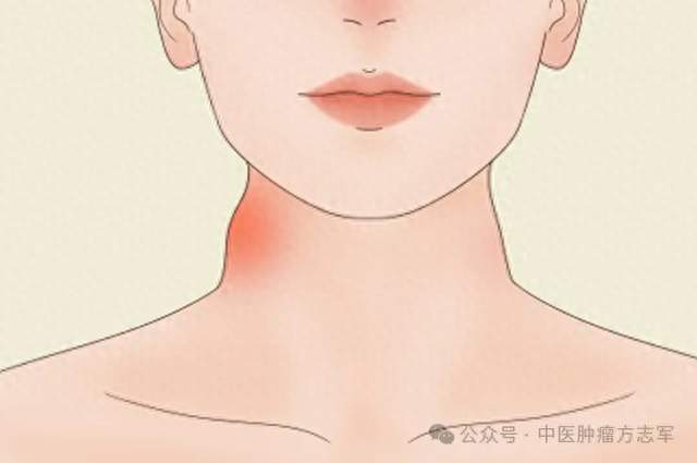 癌症复发、扩散时，身体可能会发出这6个预警信号！