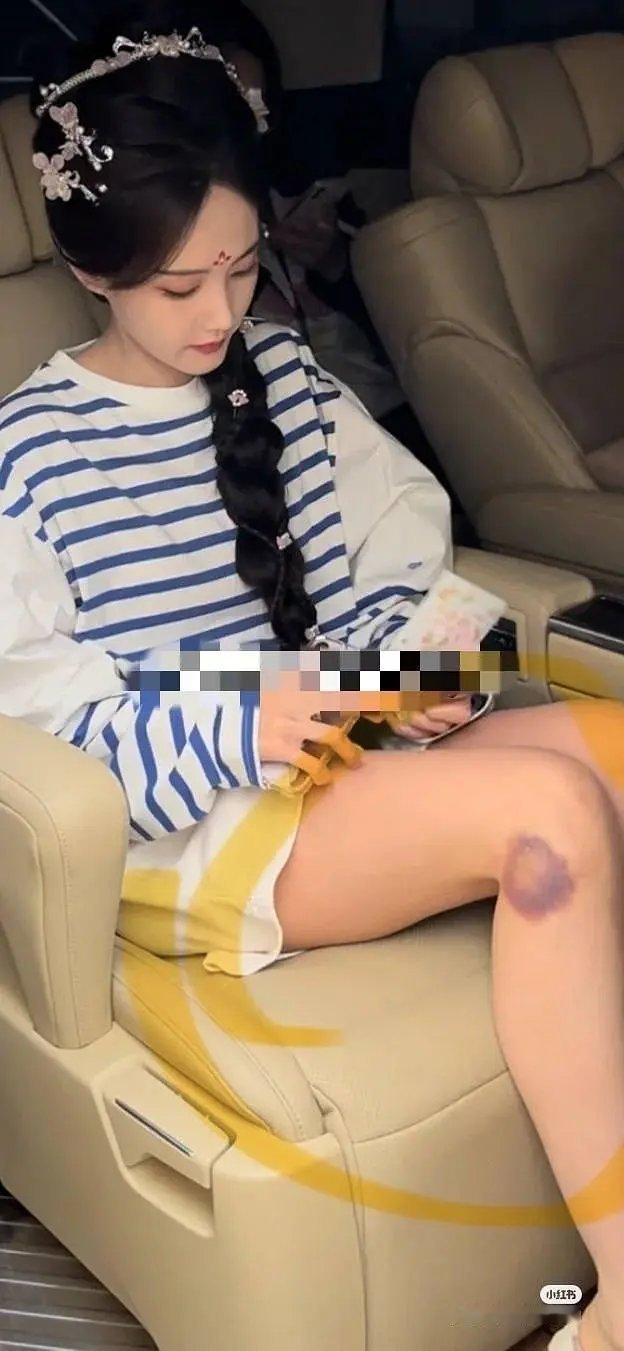 桐姐对工作是挺认真的，这么大块淤青是这么来的啊 ​​​