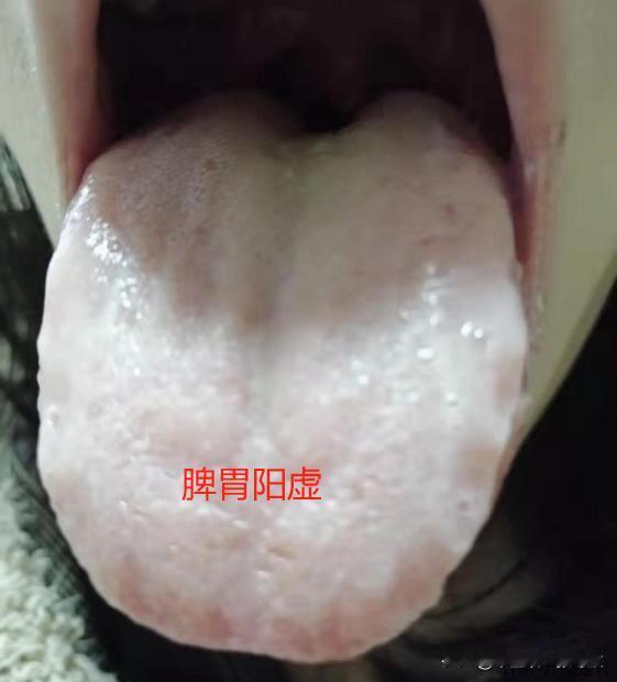 脾胃虚弱一共分3种，脾阴虚，脾阳虚，脾气虚
张医生手把手教你，怎么分辨，怎么调[