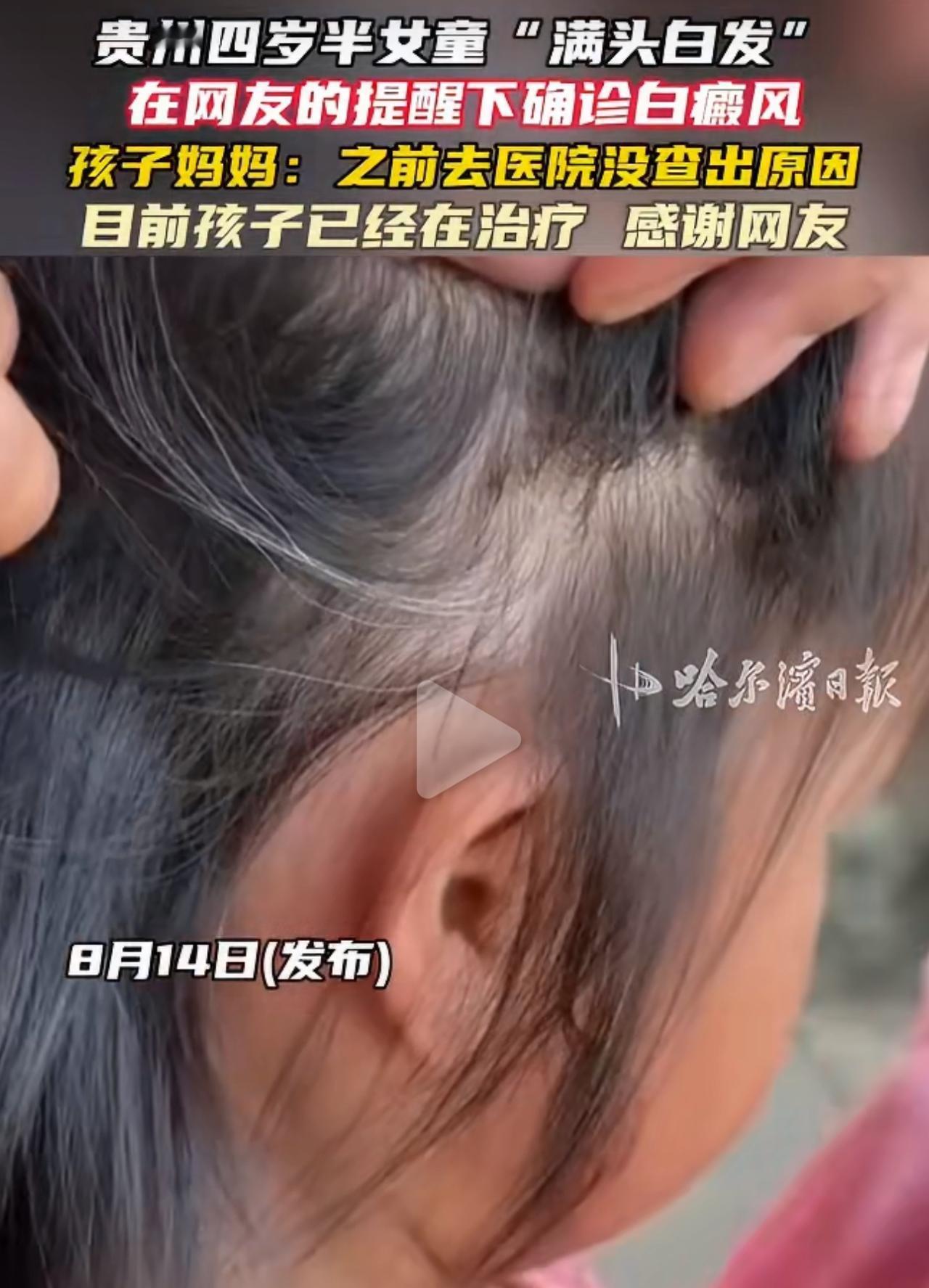贵州这位宝妈最近又后怕又庆幸。自家四岁半的女儿，半年前开始零星长白发，谁也没当回