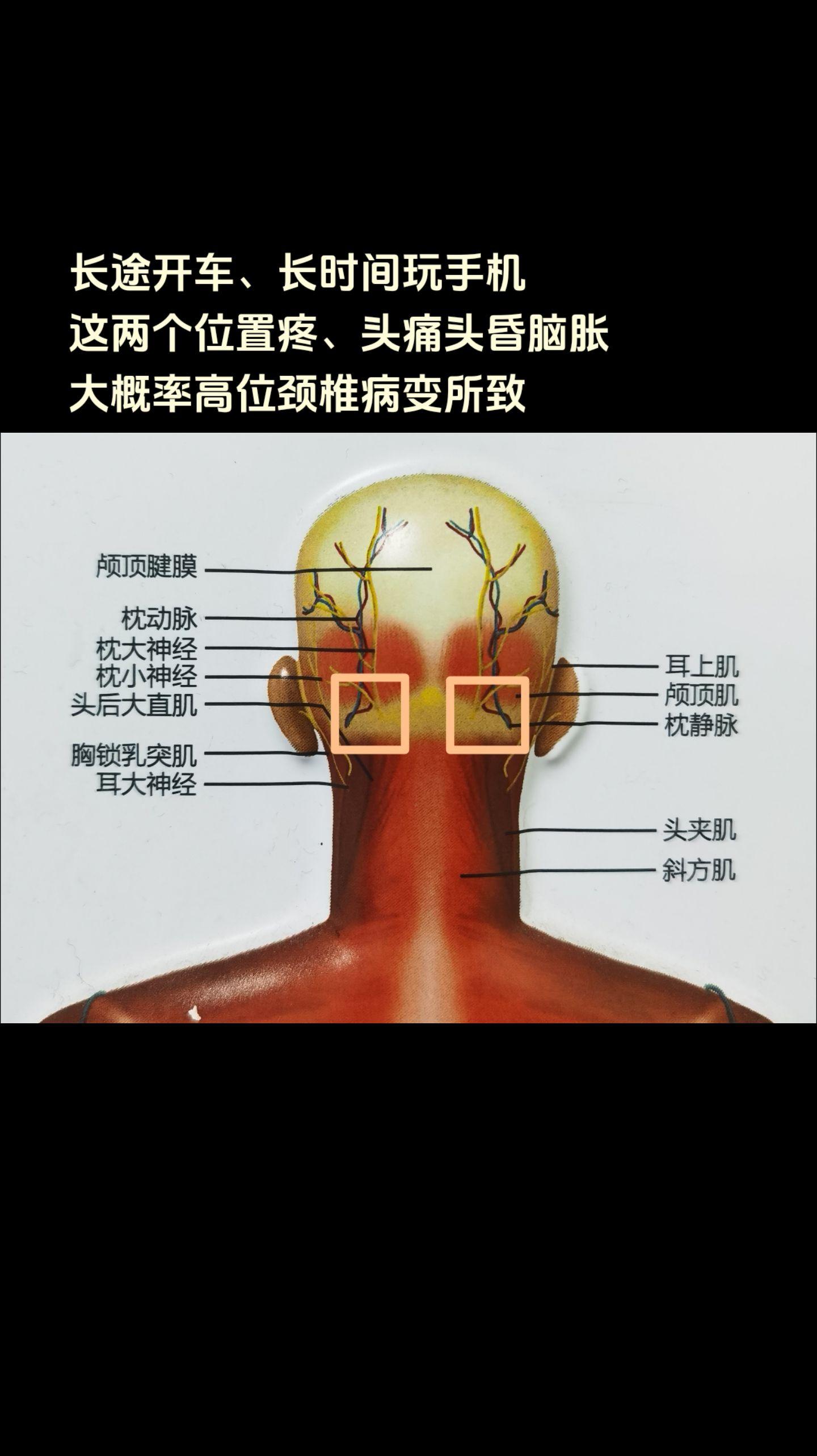 长途开车，长时间玩儿手机，这两个位置或之一疼痛，伴头痛头昏脑胀，拍个颈椎片儿看一下吧，最好MRI。