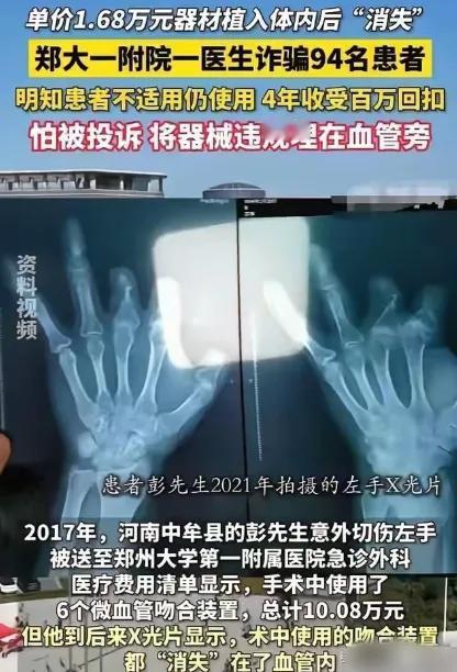 12年！他把农民工的断指手术做成了"提款机"。

一个木工被电锯削掉拇指，咬牙借