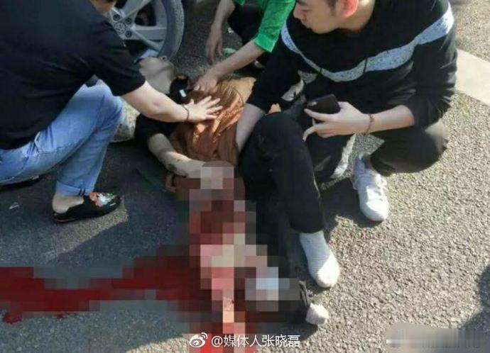 【爸爸送孩子上学被撞截肢，醒来第一句话让人泪目】昨天上午，温州一位爸爸正要送孩子