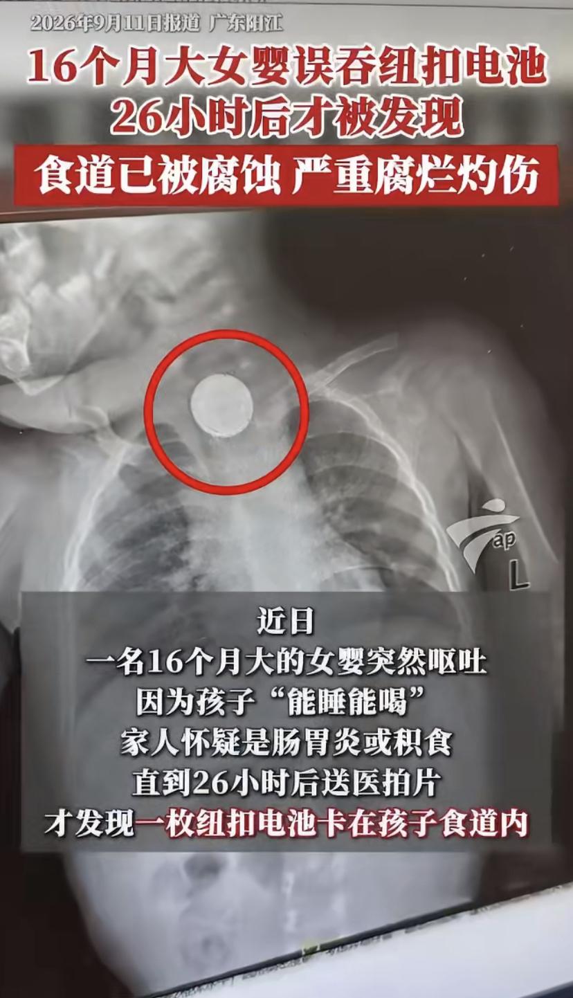 16个月大的宝宝突然呕吐，家人以为是吃坏肚子或积食，想着"能睡能喝"就没太在意。