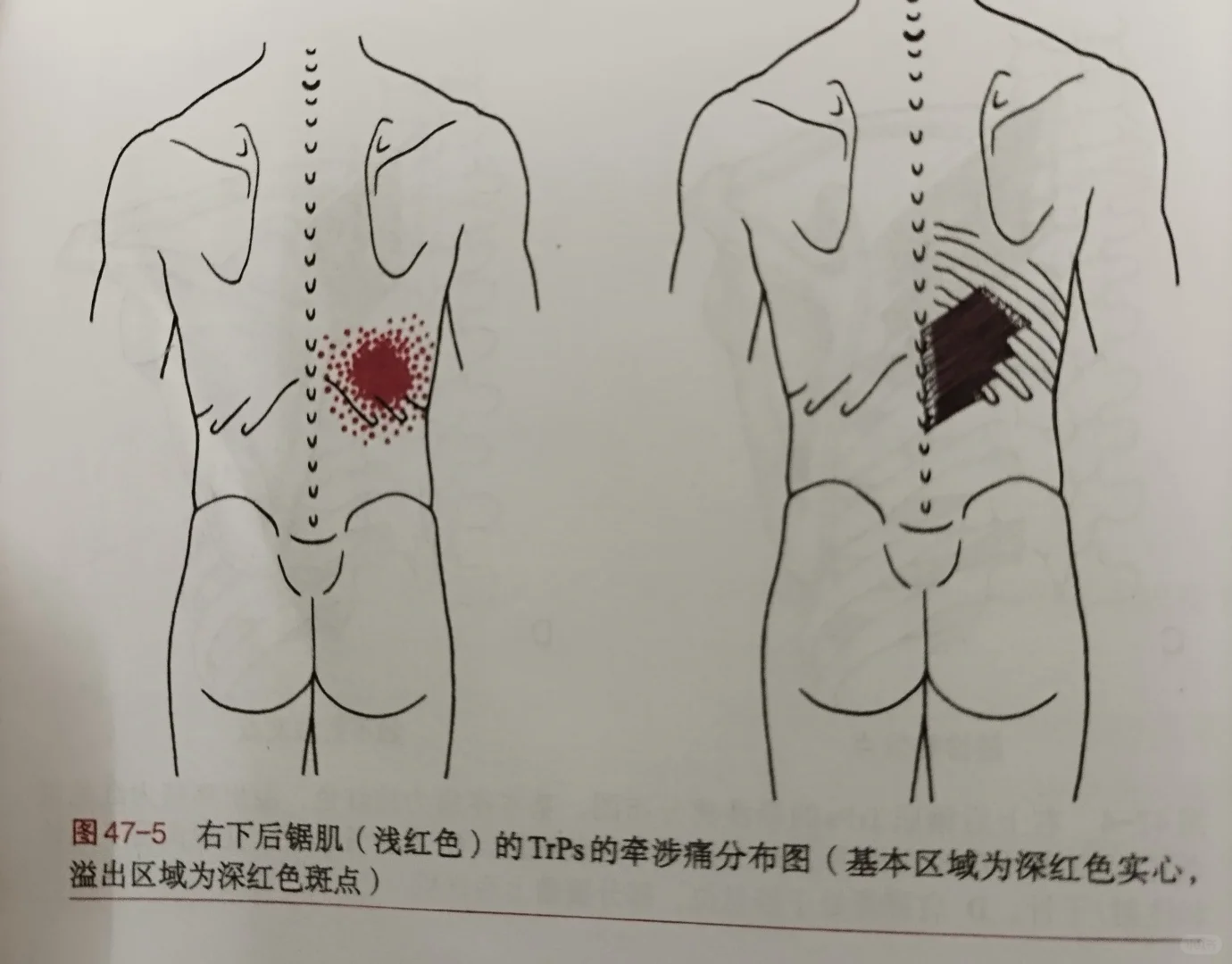 上后锯肌和下后锯肌症状