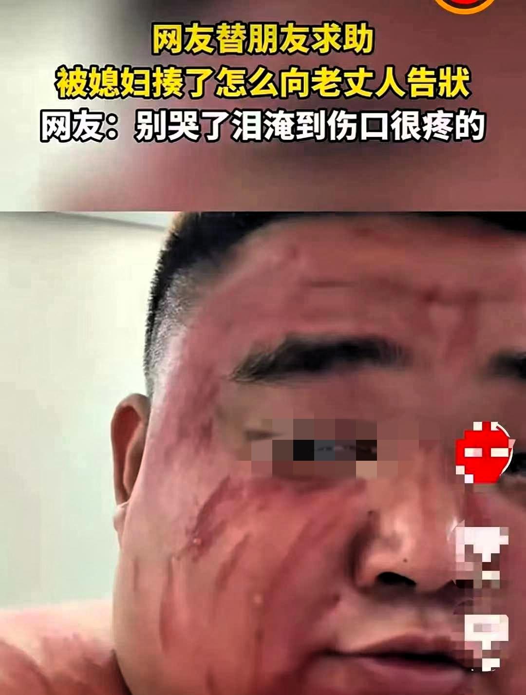 湖北，一男子被媳妇打了，脸部留下多处擦伤与淤青。心生委屈的他，一早便来到朋友家中