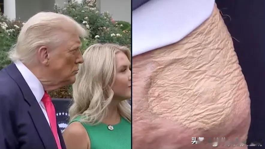 明确了！
＃特朗普被确诊患静脉疾病＃

问了一下deepseek,常见的静脉疾病