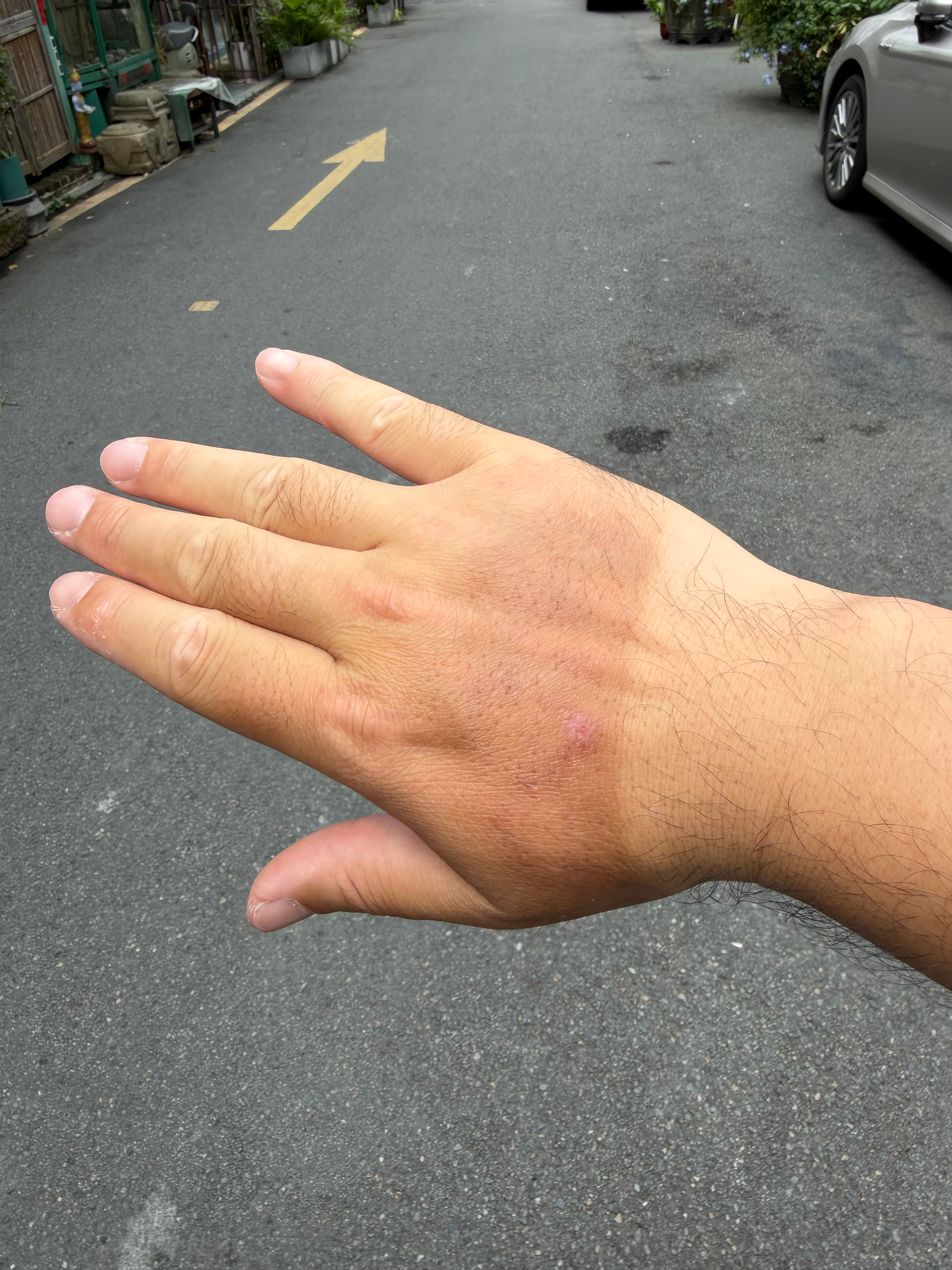 过度防晒 这个话题我有发言权，给你看看我的手图1是转完冈仁波齐，被紫外线灼伤了，