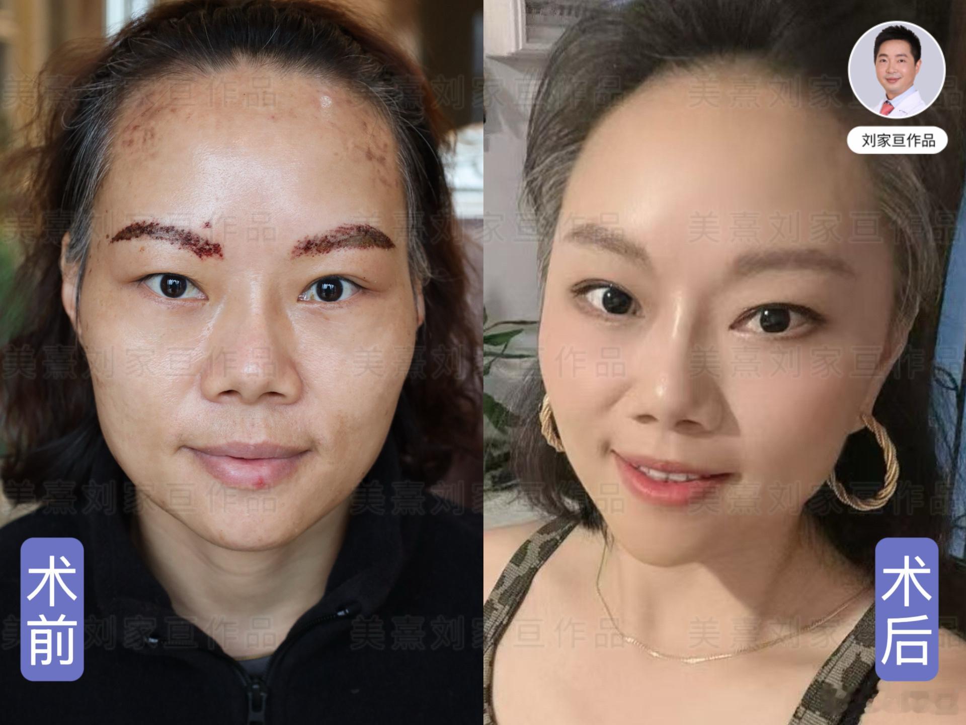 假体丰太阳穴，变化还挺大的，流畅的轮廓更显年轻！ 