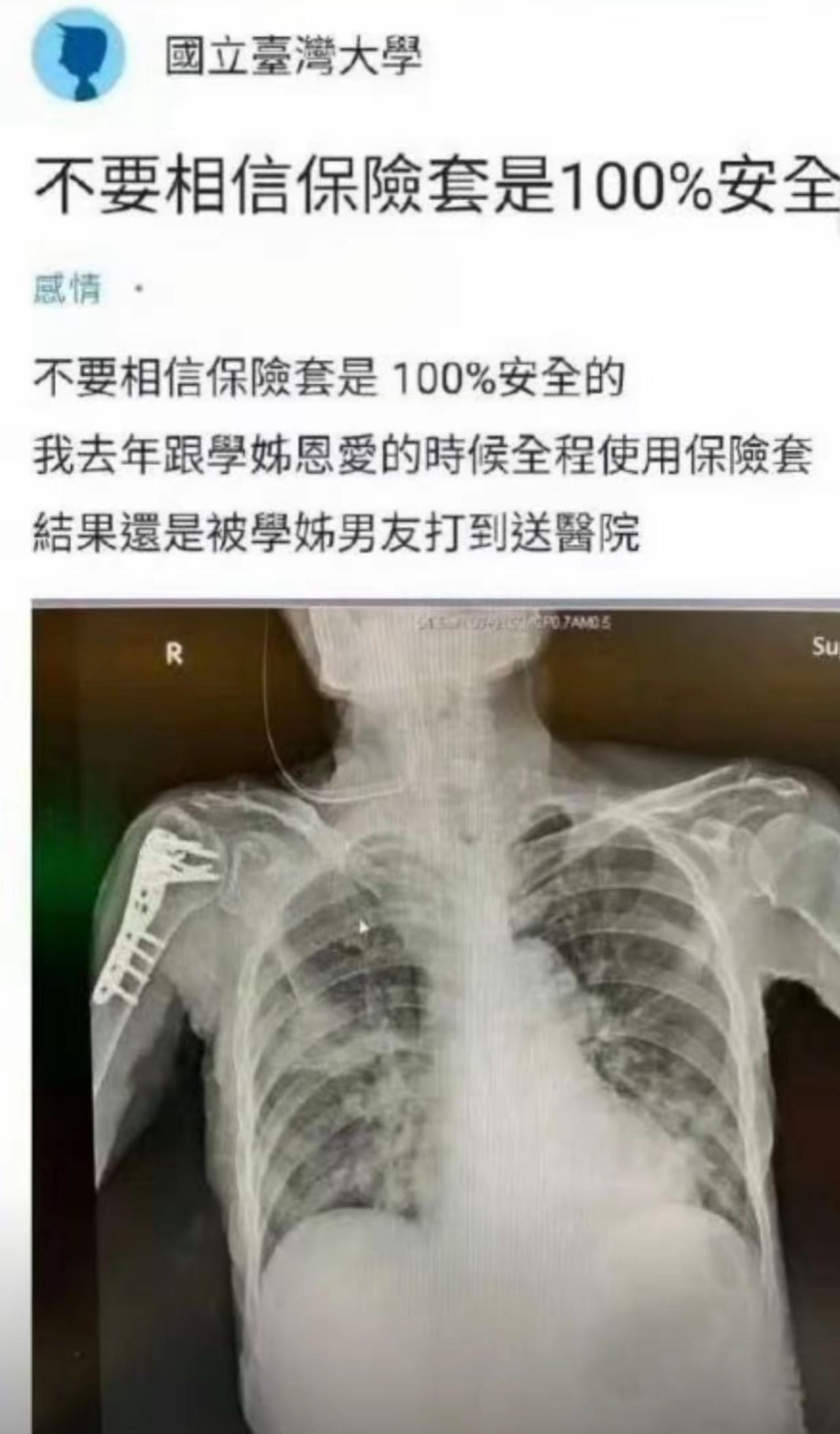 大伙一直以为保险只防意喜当爹，这位同学亲身踩坑解锁了全新短板。
全程规范佩戴没半