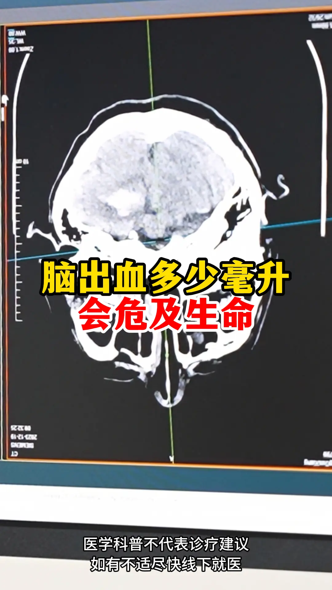 脑出血多少毫升 会危及生命。有人疑问最严重的脑出血是什么？在临床上，脑...