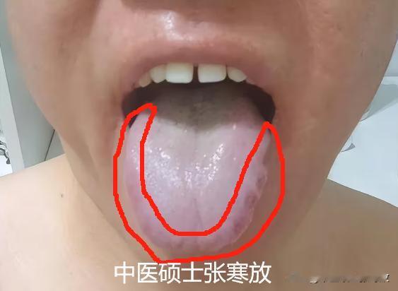 这种舌头说过好几次了，千万不要当作简单的脾虚[狗头][狗头][狗头]
患者主诉常