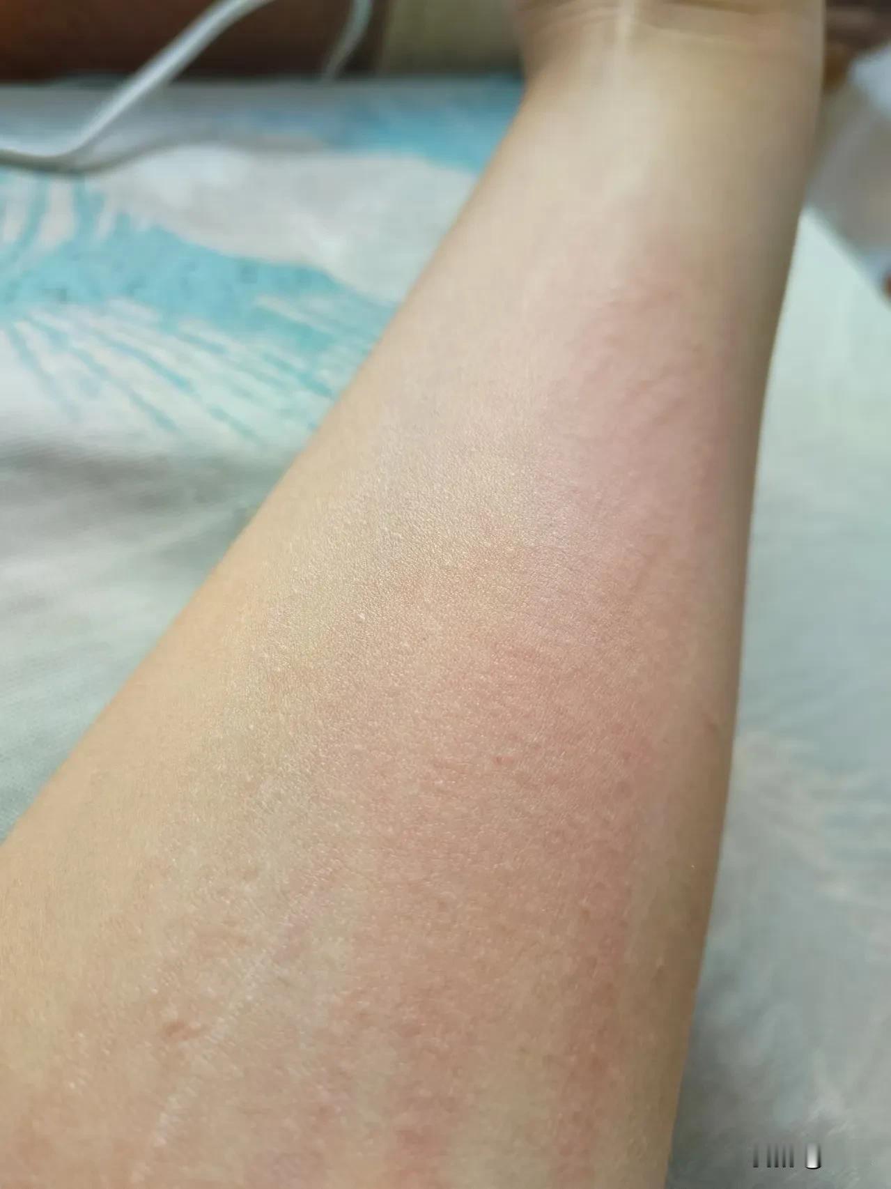 我荨麻疹已经好了几个月没痒，最近不知道咋回事每次用热水冲凉时候就有点痒然后就忍不