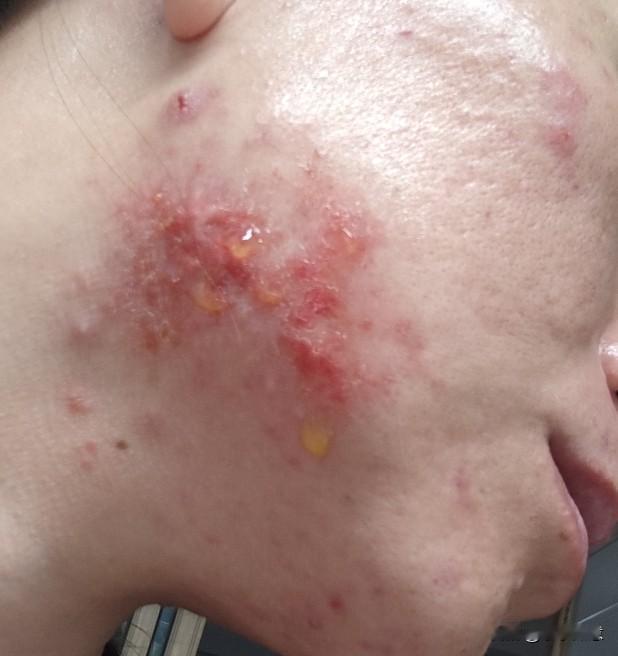 看到我这脸都没心情再去摆摊了
我脸是油性皮肤
经常反反复复的长痘
去医院看过很多